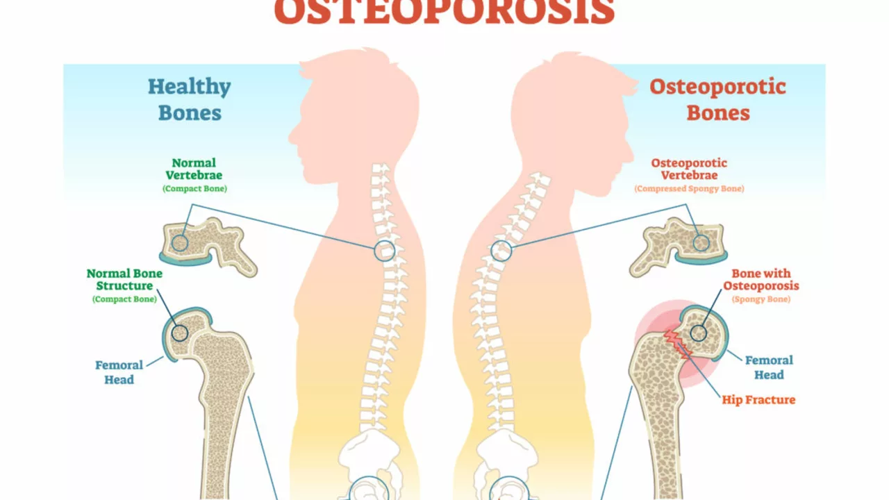 The Connection Between Tendonitis and Osteoporosis